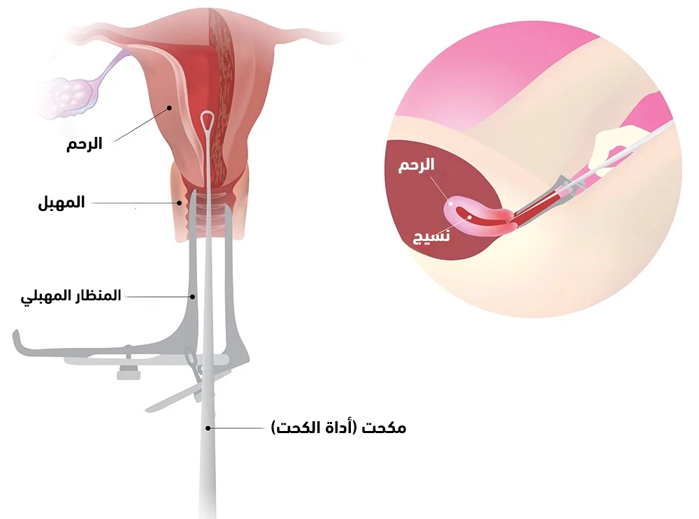 لماذا يتم إجراء عملية توسيع وكحت الرحم؟